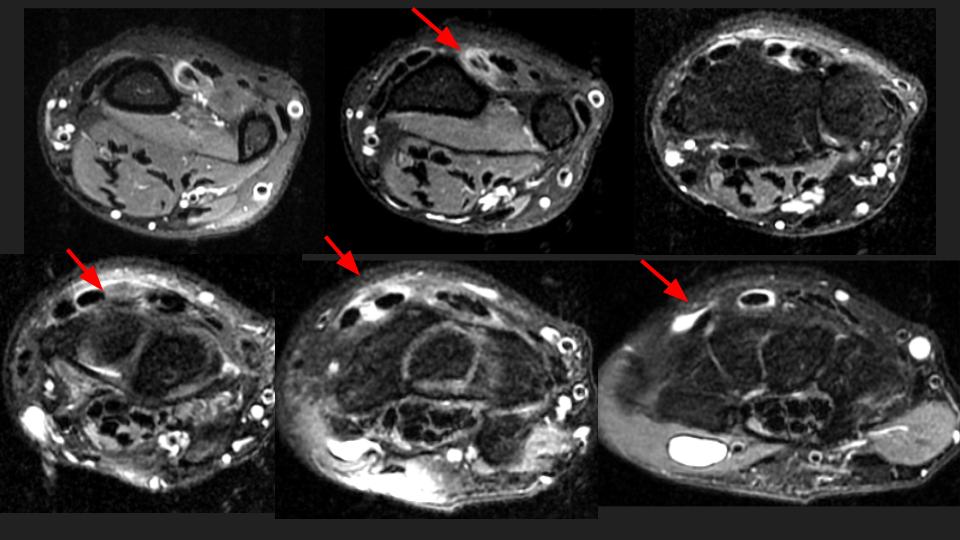 Figure 1 for case extensor pollicis longus tendon ( RID2378 )